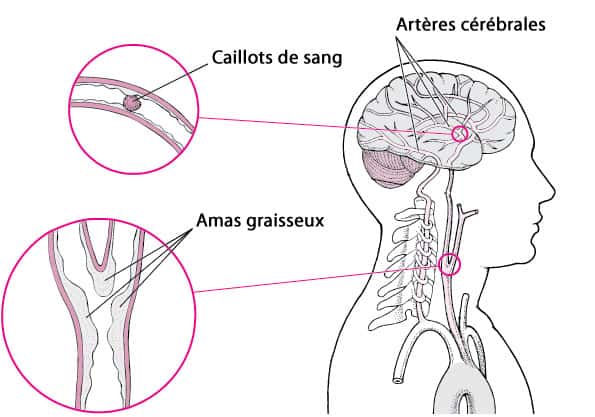 leucopathie vasculaire